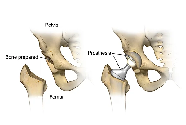 Hip Replacement