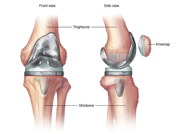 Knee Replacement