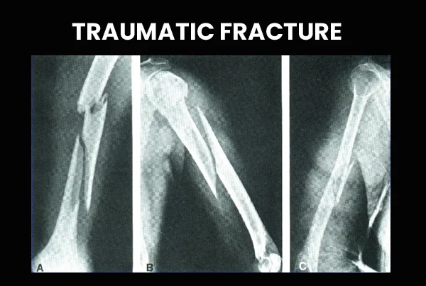 Traumatic Fracture